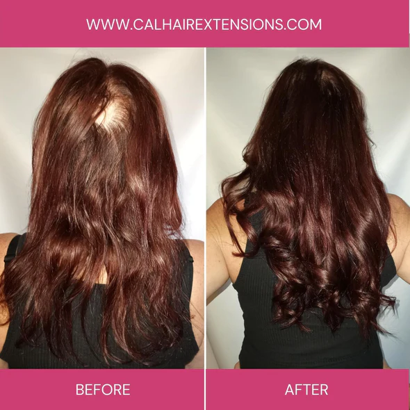 Alopecia Areata