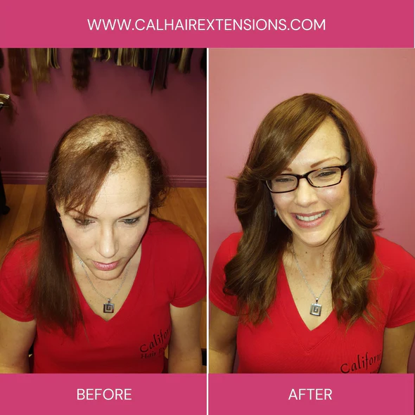 Trichotillomania