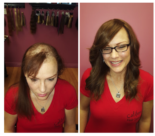 Hair Loss